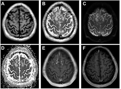 Clinical characteristic of myelin oligodendrocyte glycoprotein antibody associated cortical encephalitis in adults and outcomes following glucocorticoid therapy
